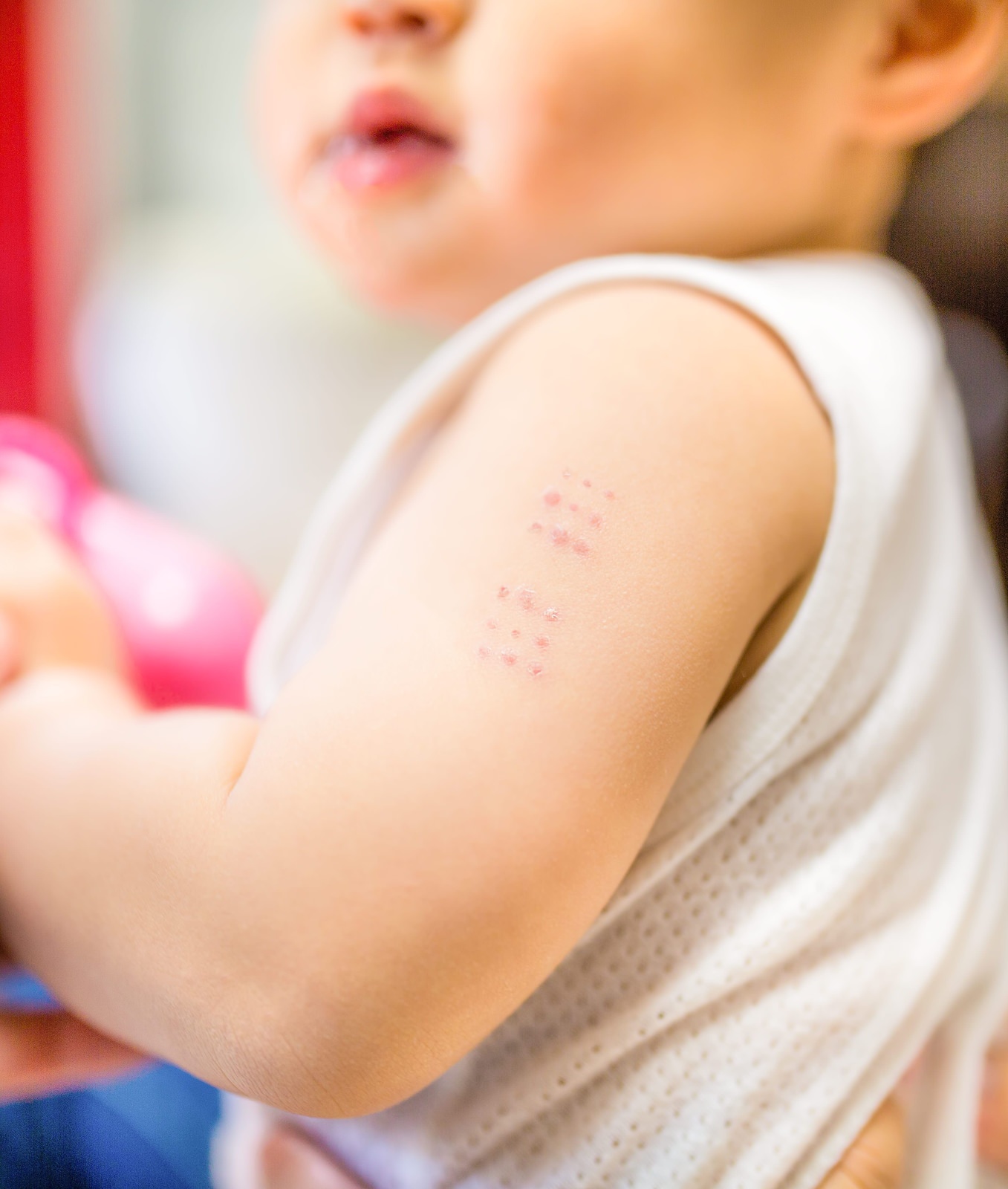 BCGワクチンの接種痕（赤ちゃんの腕）BCGワクチンの接種痕（赤ちゃんの腕） ［モデル：Lisa］