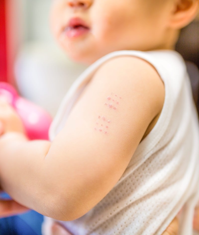 「BCGワクチンの接種痕（赤ちゃんの腕） | フリー素材のぱくたそ」の写真［モデル：Lisa］