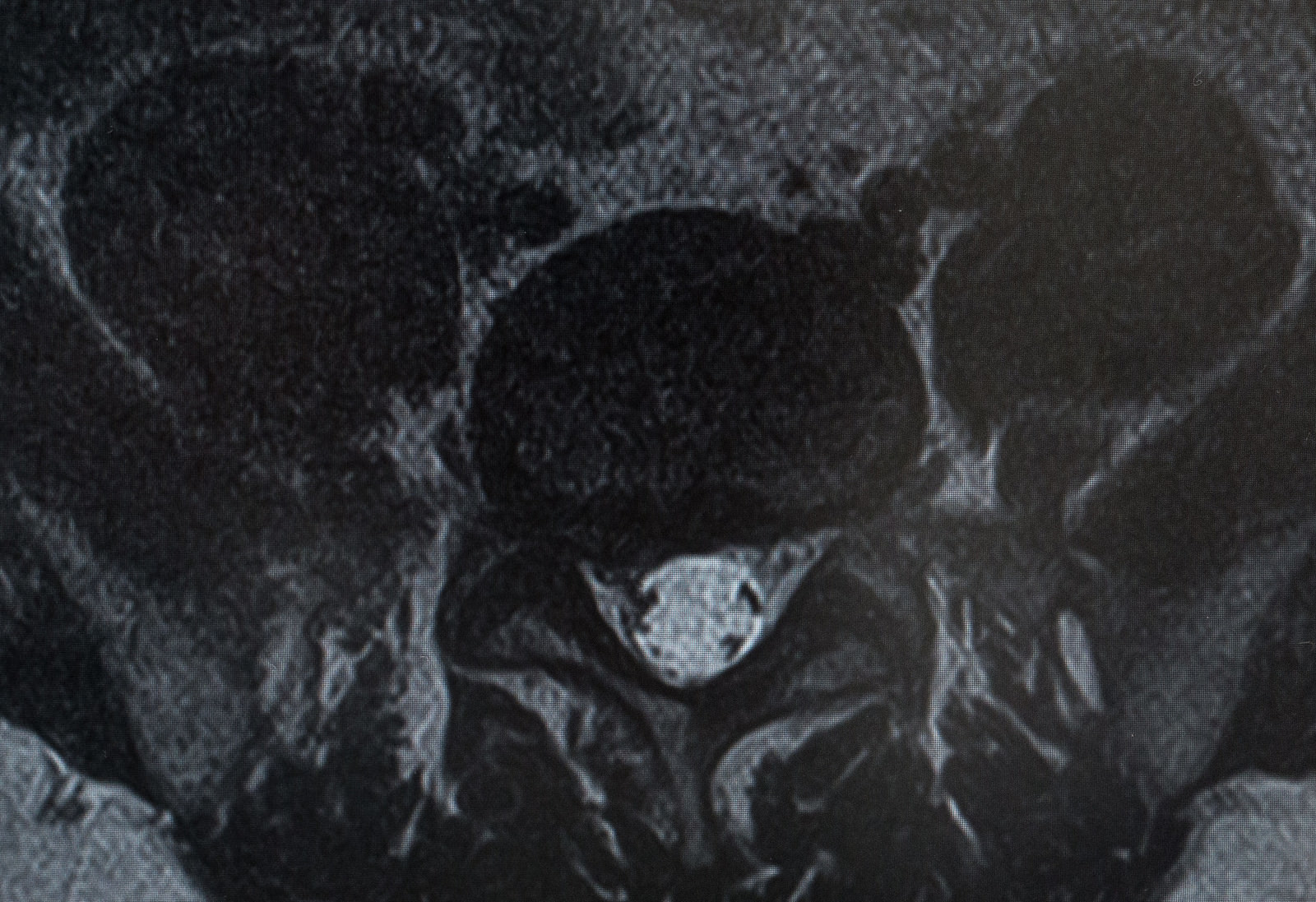「椎間板ヘルニアによって右の神経根が圧迫（MRI輪切り）」の写真