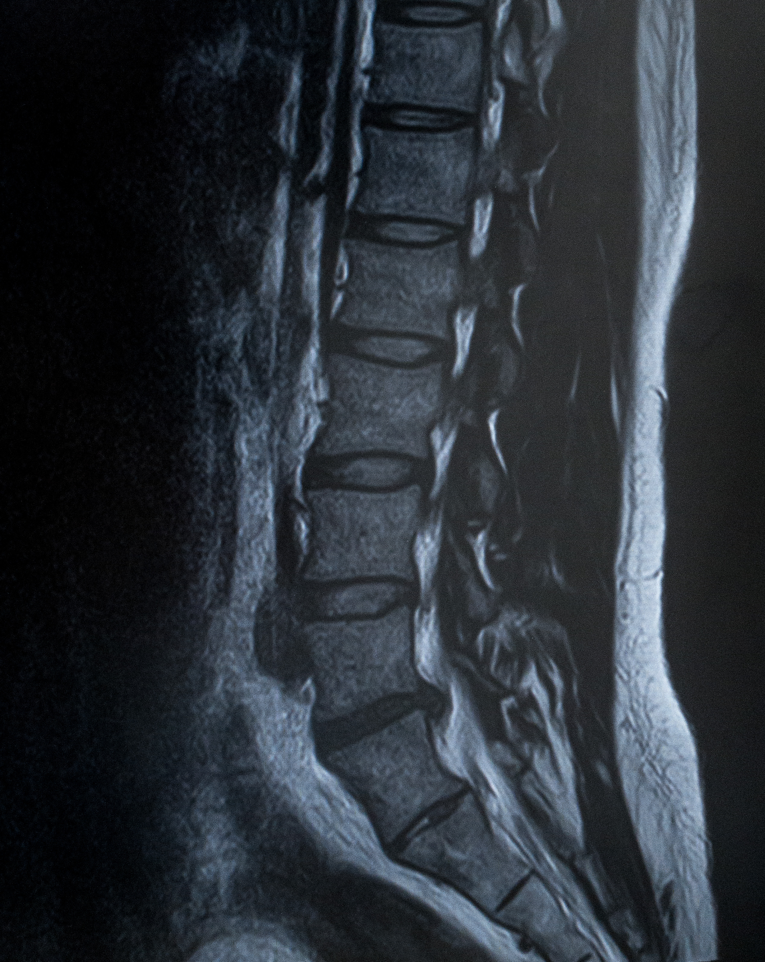 腰椎5番が椎間板ヘルニア Mri の写真を無料ダウンロード フリー素材 ぱくたそ