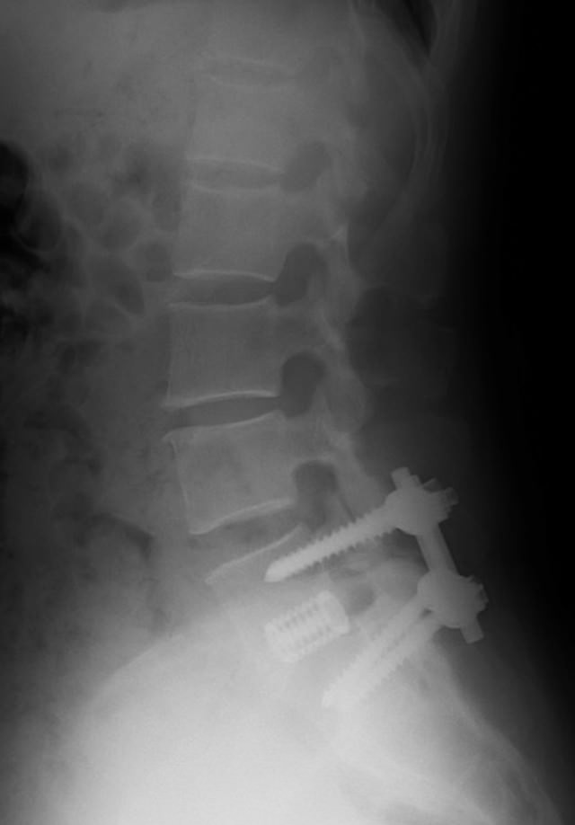 「腰部脊柱管狭窄症治療のレントゲン写真」のフリー写真素材